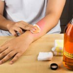 Is it safe to remove moles with apple cider vinegar?