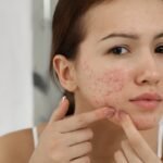 Pigmentation, acne scars or ageing? 5 questions that can help identify the right treatment path